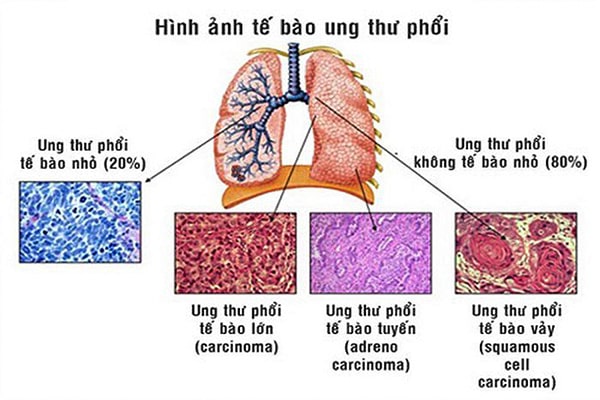 Hình ảnh tế bào ung thư phổi