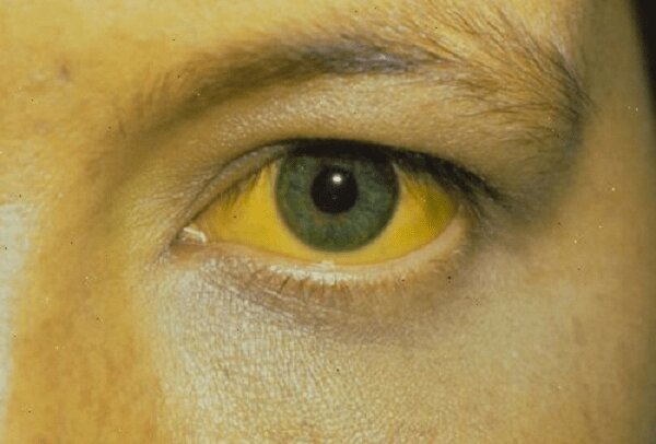 Vàng da vàng mắt là dấu hiệu bệnh viêm gan B