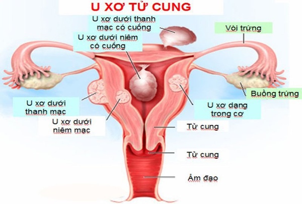 U xơ tử cung được phân thành 4 loại dựa vào vị trí khối u