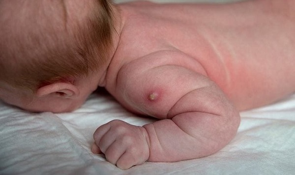 Viêm da mủ ở trẻ sơ sinh được xếp vào nhóm bệnh truyền nhiễm