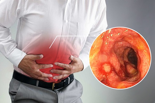 Đau dọc theo khung đại tràng hoặc đau quặn thắt ở bụng là dấu hiệu viêm đại tràng điển hình