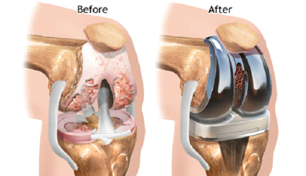 Hình ảnh trước và sau khi phẫu thuật thay khớp gối