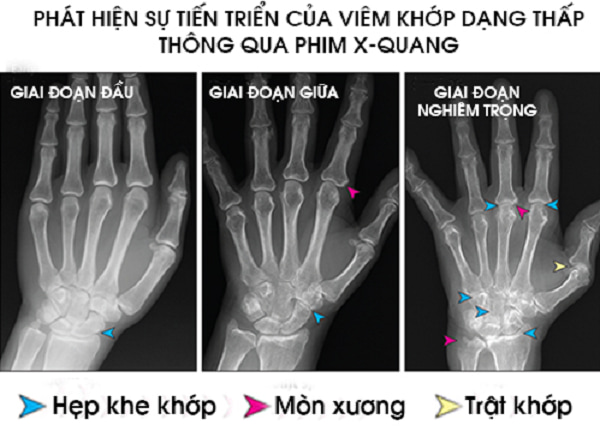 Hình ảnh chụp X quang viêm khớp dạng thấp