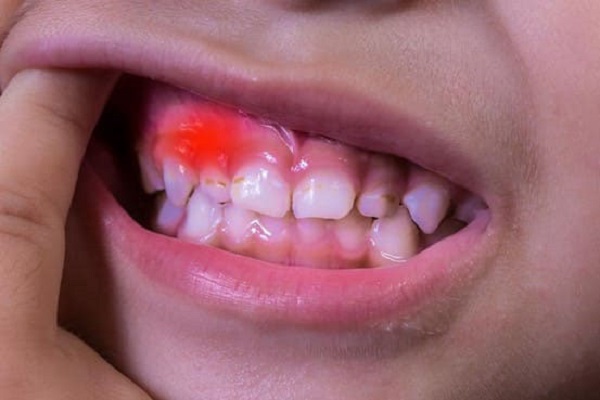 Trẻ bị viêm lợi chủ yếu là do chưa vệ sinh răng miệng sạch sẽ
