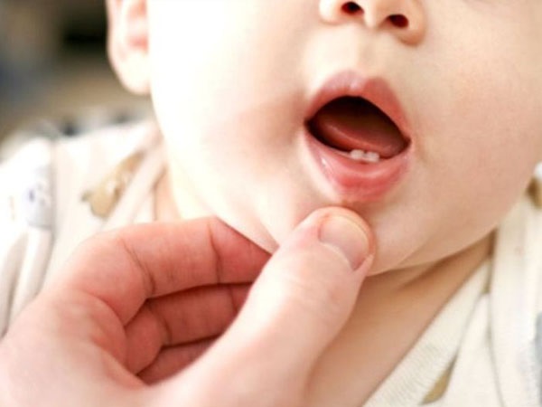 Trẻ bị viêm lợi có thể do mọc răng