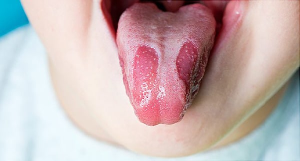 viêm lưỡi bản đồ ở trẻ em là một tình trạng rối loạn lành tính ở bề mặt lưỡi