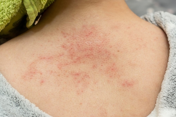 dấu hiệu viêm nang lông là trên da xuất hiện các nốt đỏ lan rộng