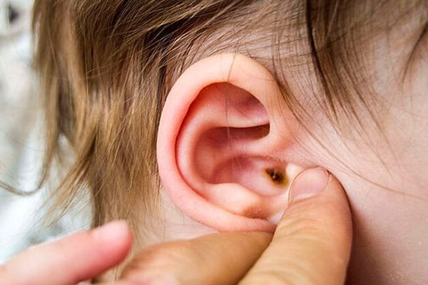 Chảy dịch, mủ ở tai là một trong những dấu hiệu sớm của bệnh viêm ống tai ngoài