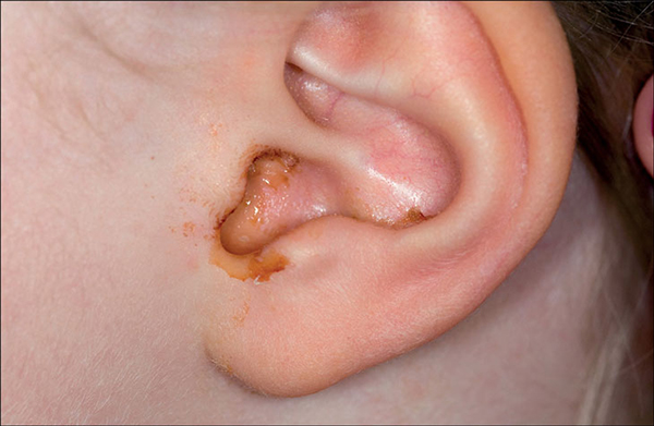 Viêm tai giữa tái lại nhiều lần thường kèm theo tình trạng ù tai.