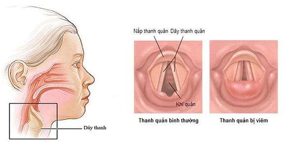 Trẻ bị viêm thanh quản: những dấu hiệu nguy hiểm ba mẹ cần lưu ý