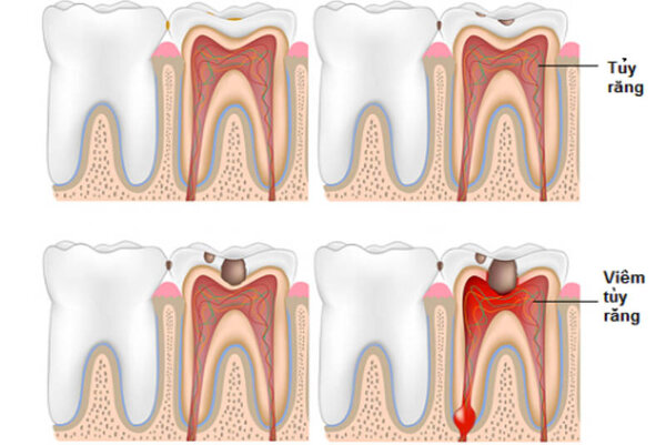 Viêm tủy răng là tình trạng tủy răng và các mô xung quanh bị viêm nhiễm