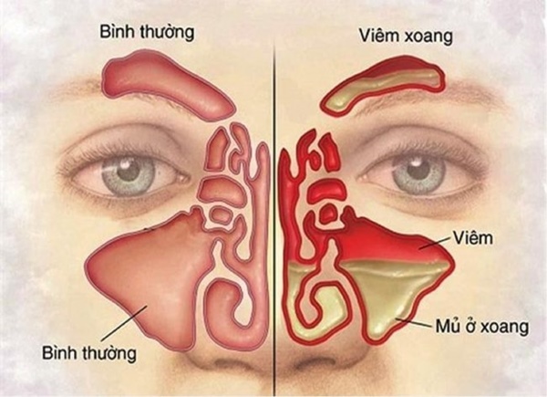 Viêm xoang là bệnh lý khá phổ biến ở Việt Nam