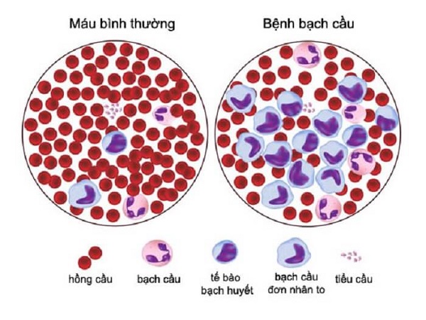 1. Tổng quan về chỉ số WBC trong nước tiểu