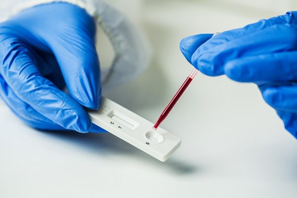 Test nhanh phát hiện kháng thể của virus SARS-CoV-2 trong máu