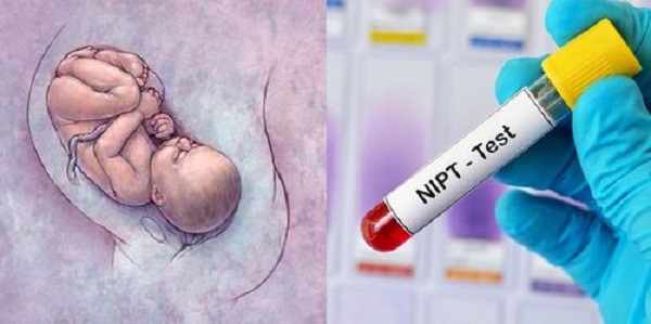 Xét nghiệm NIPT là kỹ thuật giúp sàng lọc dị tật trước sinh cho thai nhi