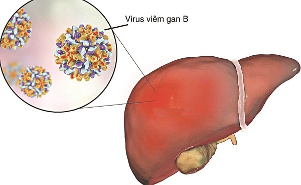 Virus viêm gan B là nguyên nhân hàng đầu gây xơ gan