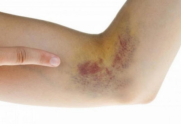 Cách chấn thương do va chạm gây xuất huyết dưới da?

