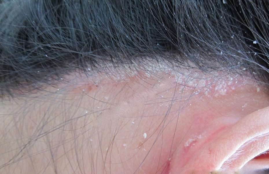 Bệnh chốc đầu (nấm da đầu) là tình trạng nhiễm trùng nông do nhiễm nấm