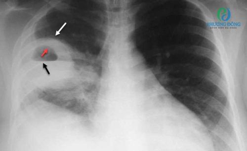 Áp xe phổi: Triệu chứng, dấu hiệu và cách điều trị