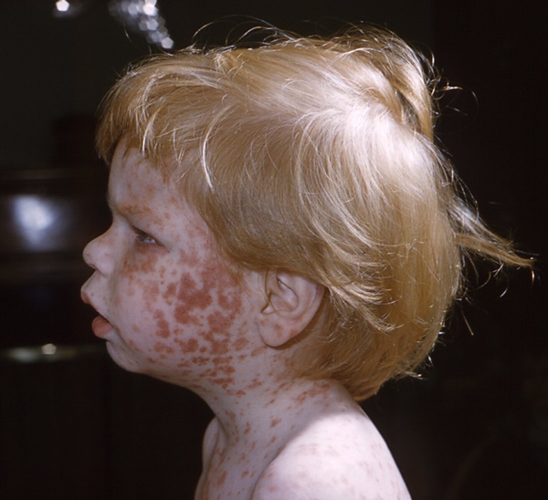 Rubella là một bệnh truyền nhiễm do virus gây ra với đặc điểm người bệnh bị phát ban đỏ trên cơ thể