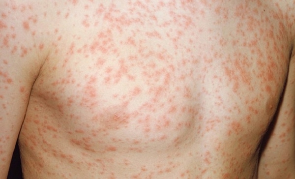 Nổi ban đỏ trên da là triệu chứng thường gặp ở bệnh Still ở người lớn