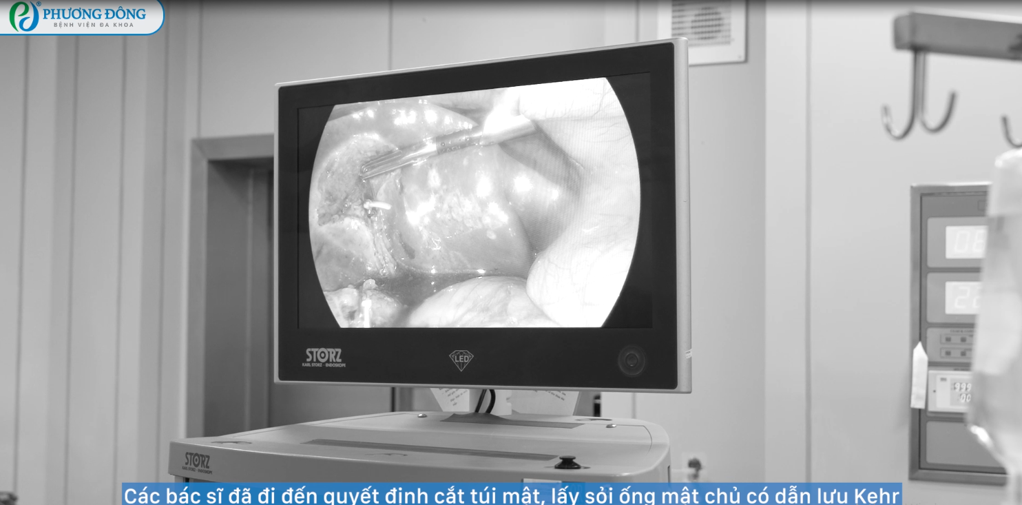 Cô gái nhập viện cấp cứu vì sỏi túi mật sau nhiều ngày đau bụng